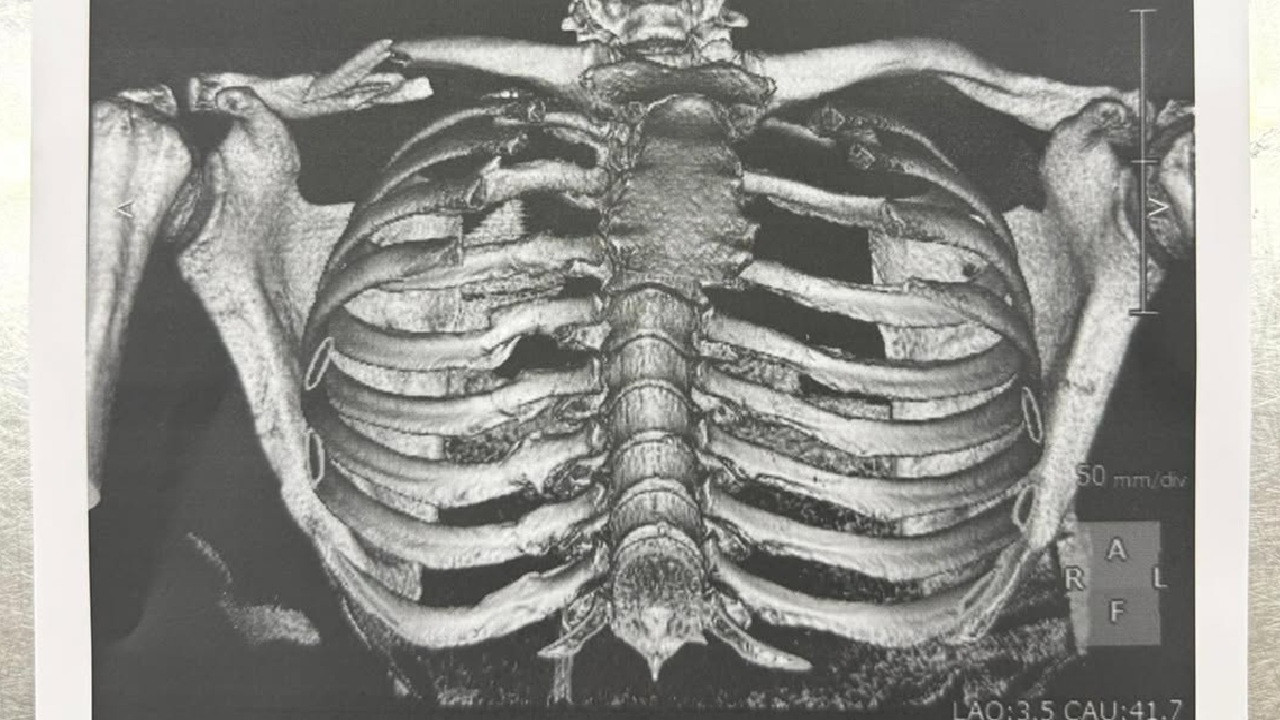 Jorge Martín Jalani Operasi Patah Tulang Selangka Usai Crash di Motegi, Dokter Ungkap Kondisinya