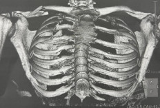 Jorge Martín Jalani Operasi Patah Tulang Selangka Usai Crash di Motegi, Dokter Ungkap Kondisinya